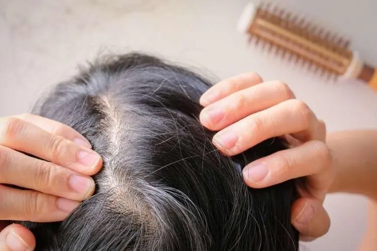 perte de cheveux traitement